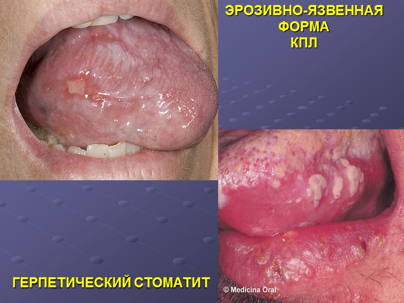 ЭРОЗИВНО-ЯЗВЕННАЯ ФОРМА КПЛ ГЕРПЕТИЧЕСКИЙ СТОМАТИТ